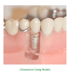 Implant dentist who does Dental implants yorktown dentist