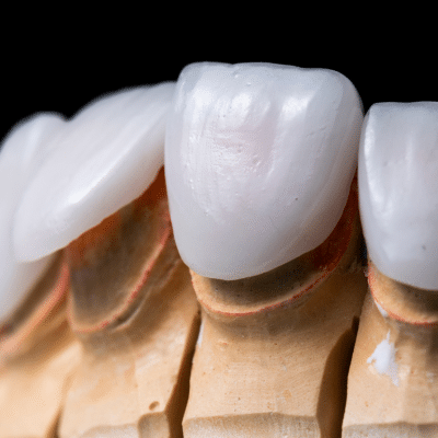 Porcelain veneers