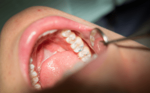 Know the symptoms of gum disease 2 Gum disease