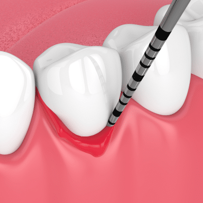 Illustration of teeth and gum disease