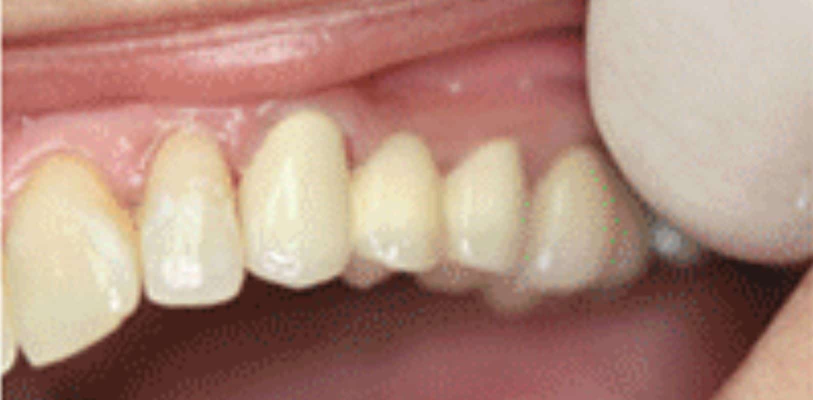 Bridges 3 Smile transformation bridges by doctor anthony martin