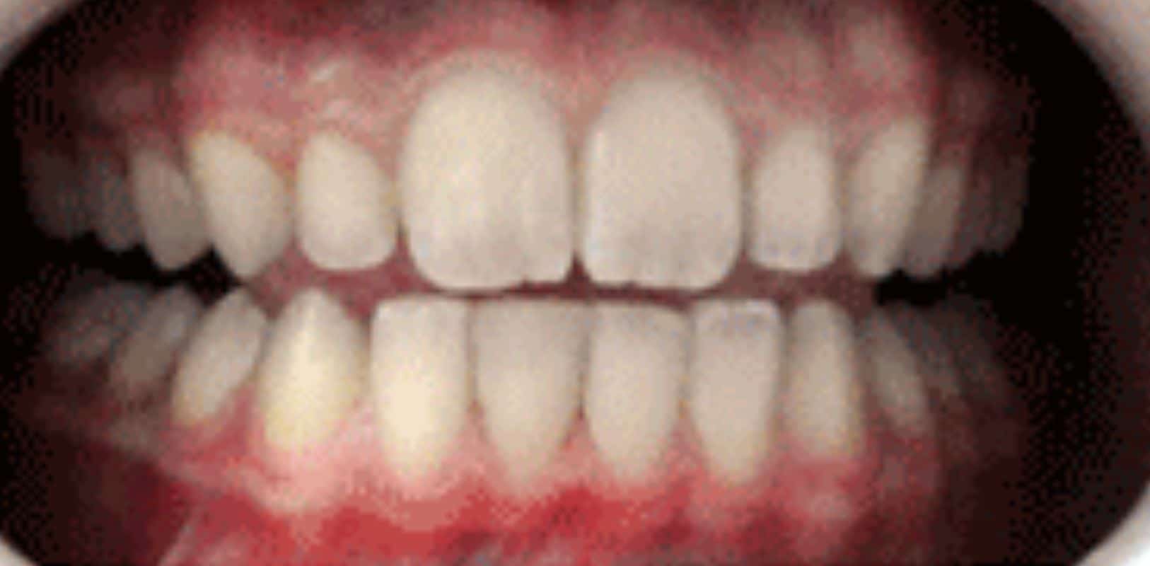 Dental bonding 3 Smile transformation bonding by doctor anthony martin