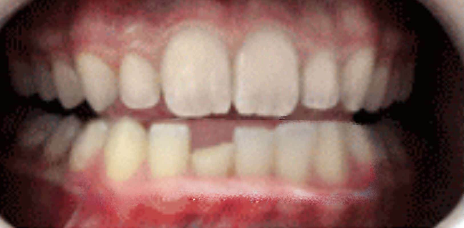 Dental bonding 2 Smile transformation bonding by doctor anthony martin