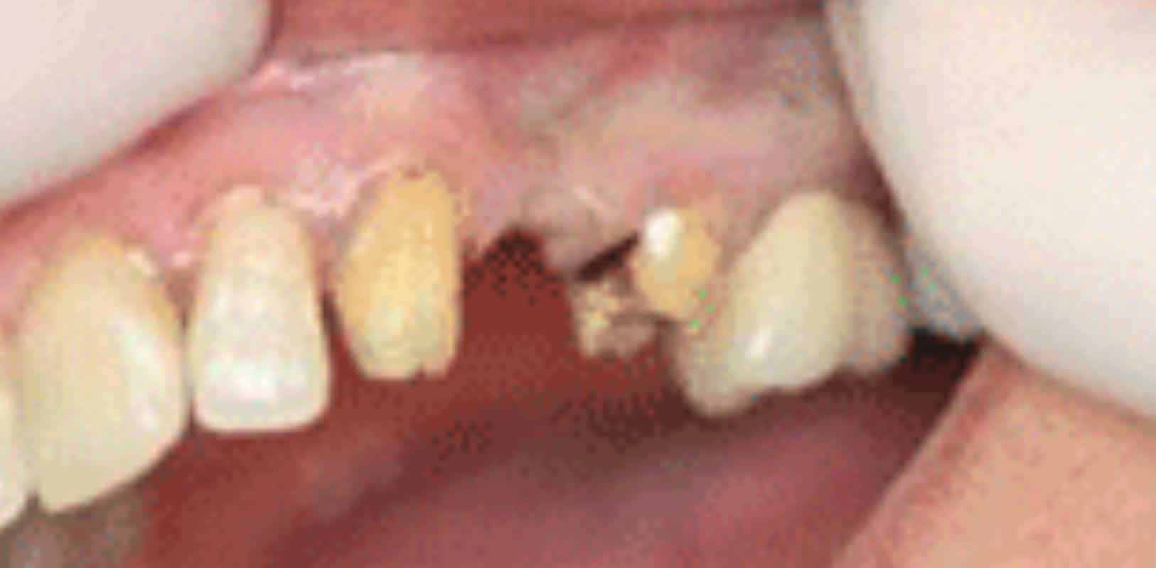 Bridges 2 Smile transformation before bridges by doctor anthony martin