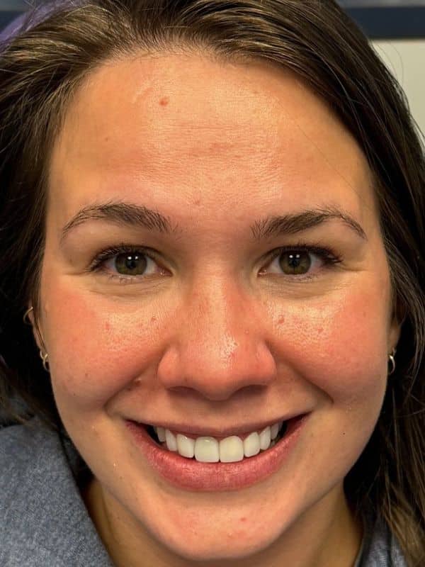 Female smile transformation by doctor anthony martin after treatment