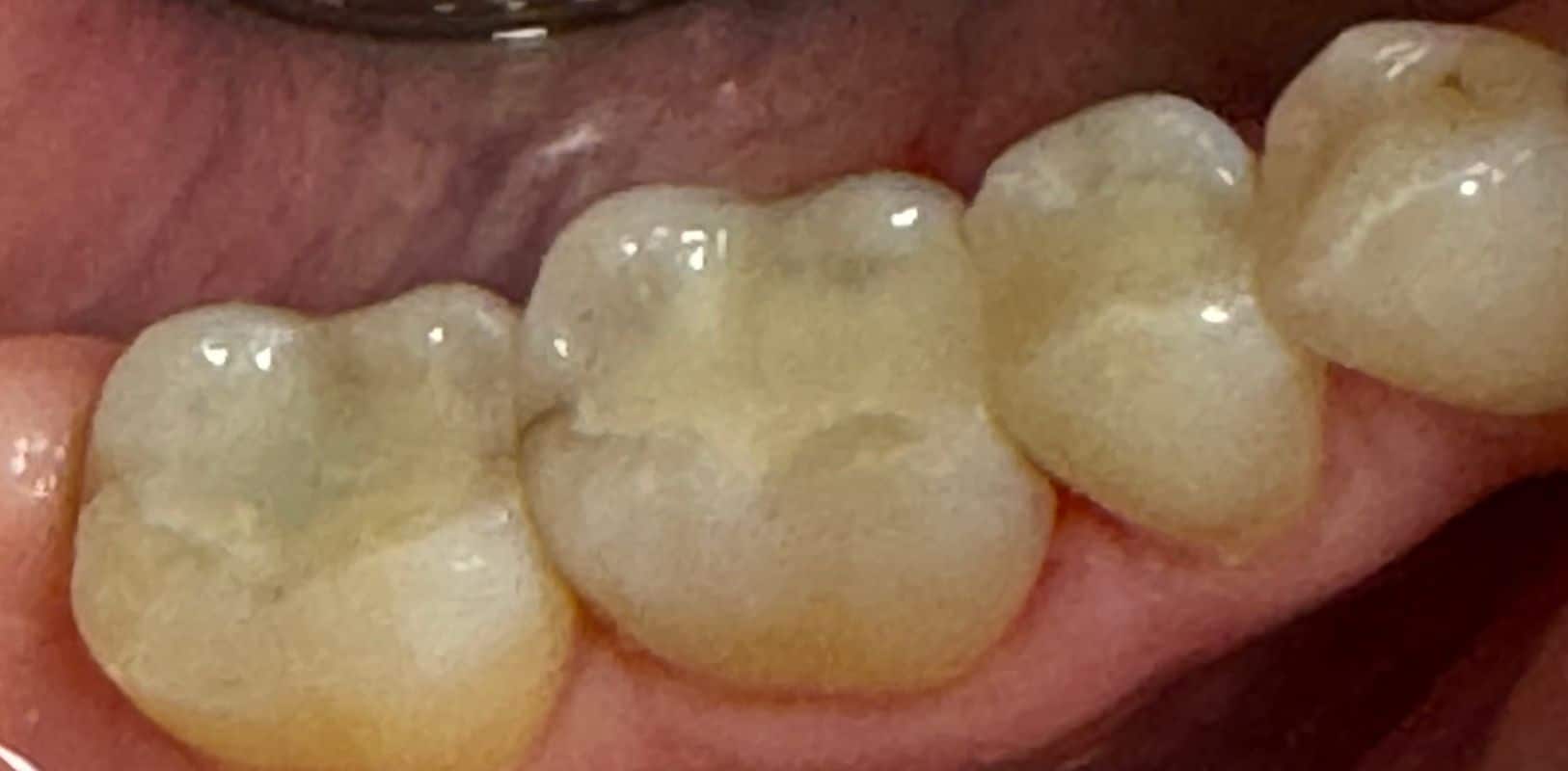 Before & after 13 Smile transformation by doctor anthony martin after treatment 10