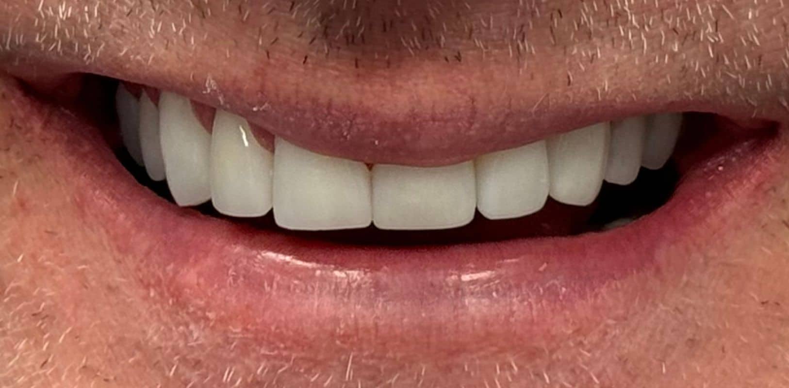 Before & after 29 Smile transformation by doctor anthony martin after treatment 11