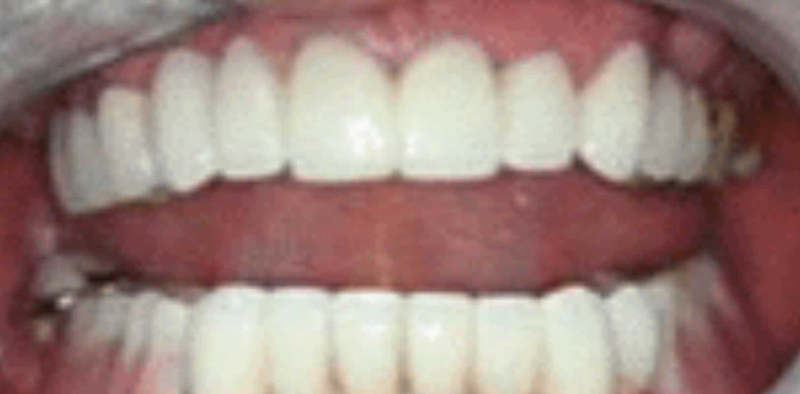 Before & after 27 Smile transformation by doctor anthony martin after treatment 6