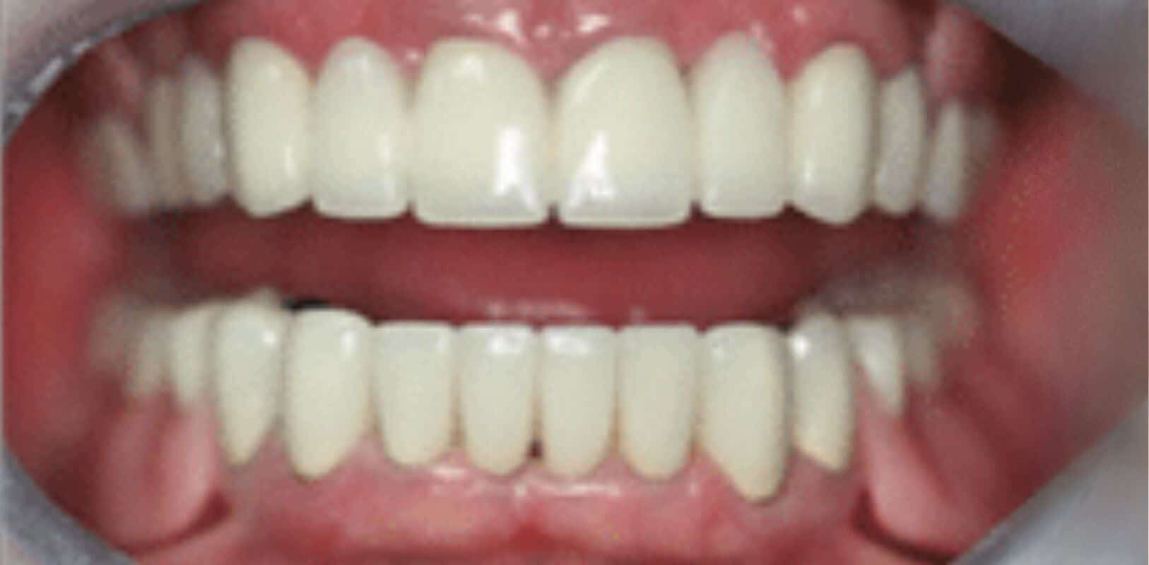 Before & after 17 Smile transformation by doctor anthony martin after treatment 7