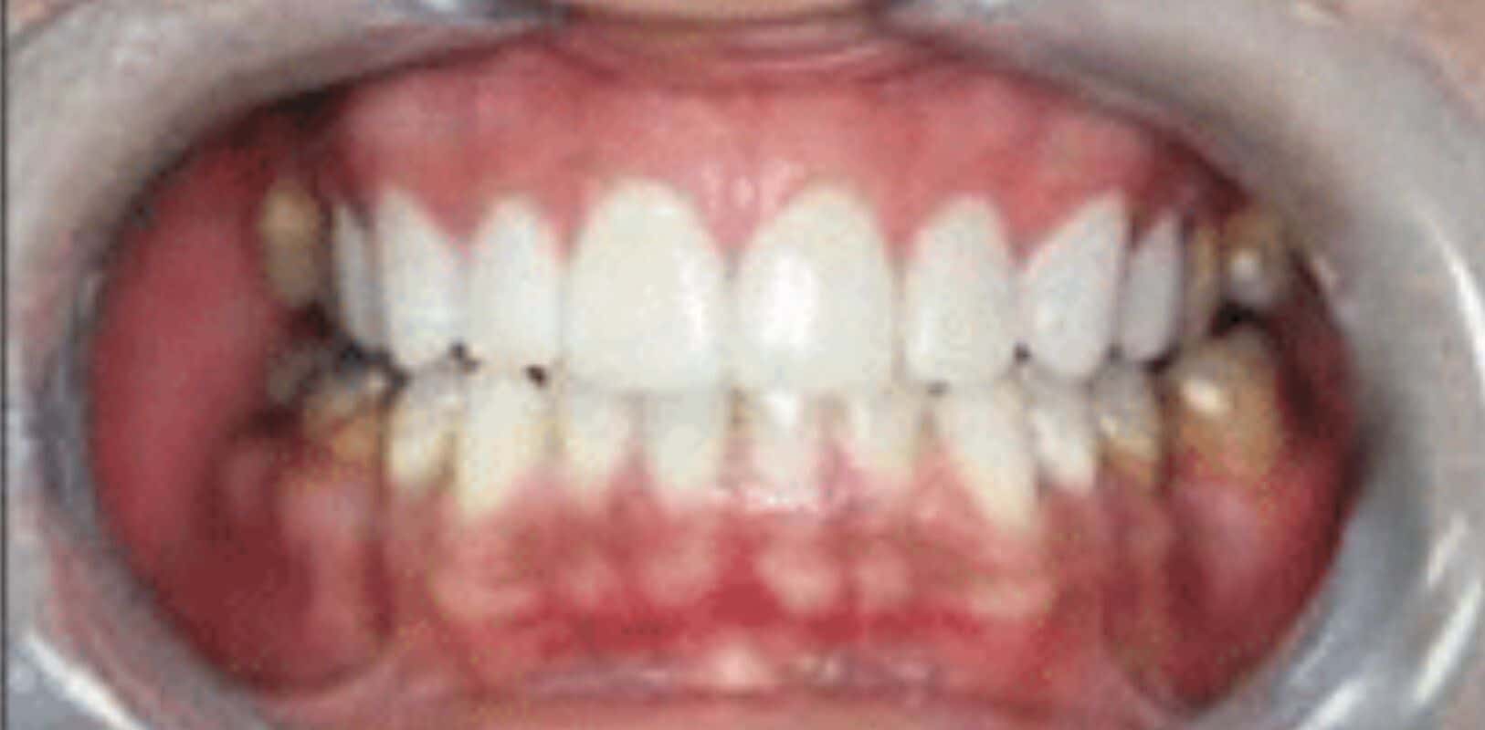 Before & after 15 Smile transformation by doctor anthony martin after treatment 8