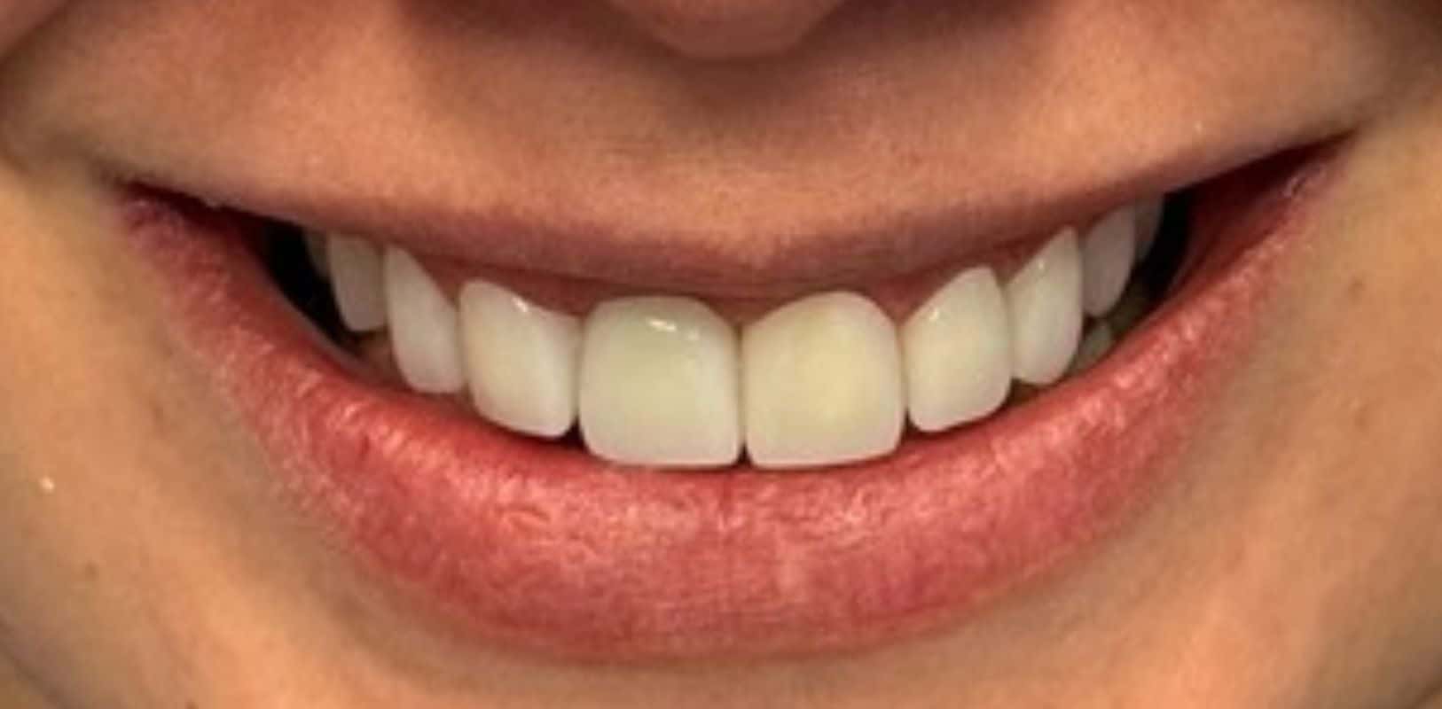 Before & after 9 Smile transformation by doctor anthony martin after treatment 9