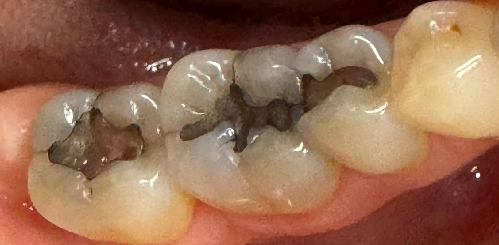 Before & after 12 Smile transformation by doctor anthony martin before treatment 10