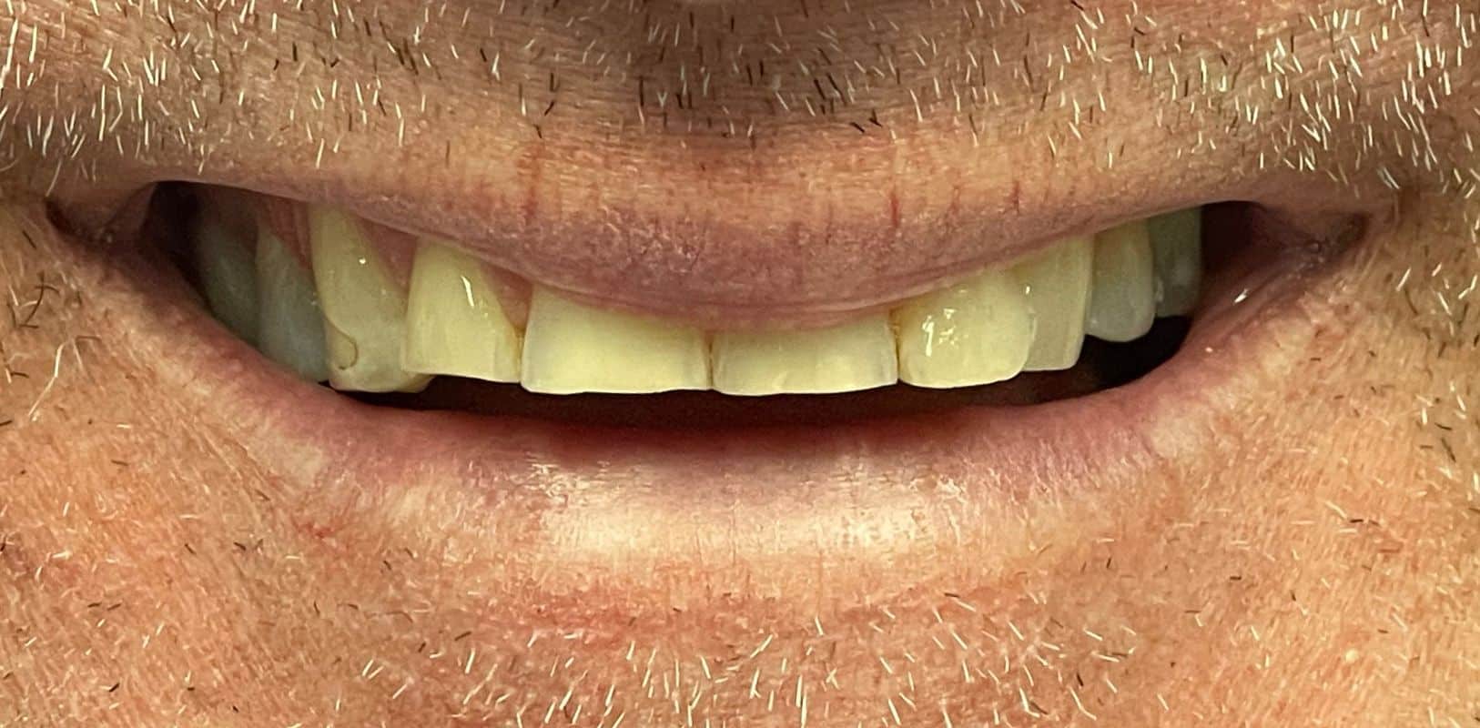 Before & after 28 Smile transformation by doctor anthony martin before treatment 11