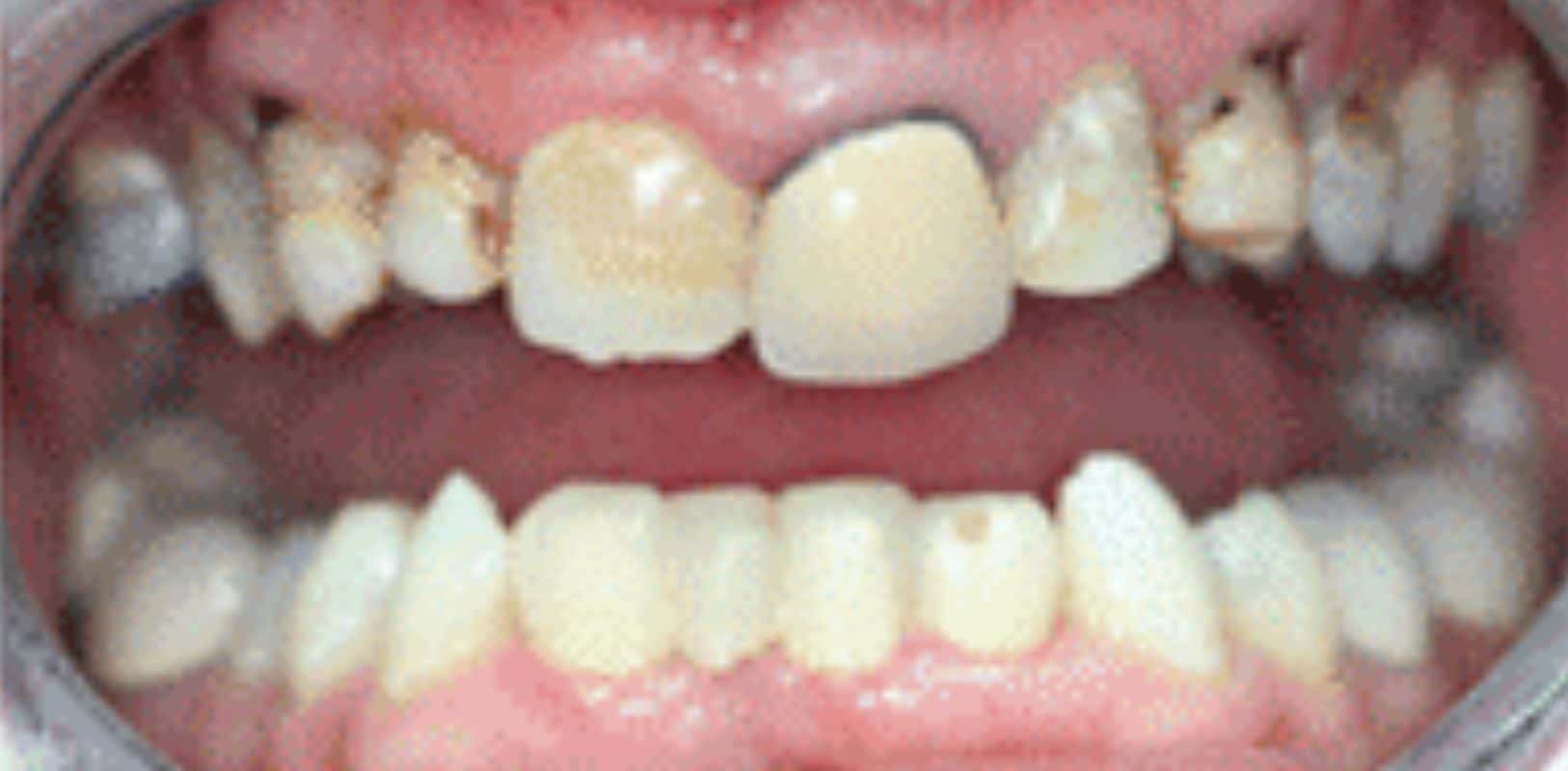 Before & after 20 Smile transformation by doctor anthony martin before treatment 4