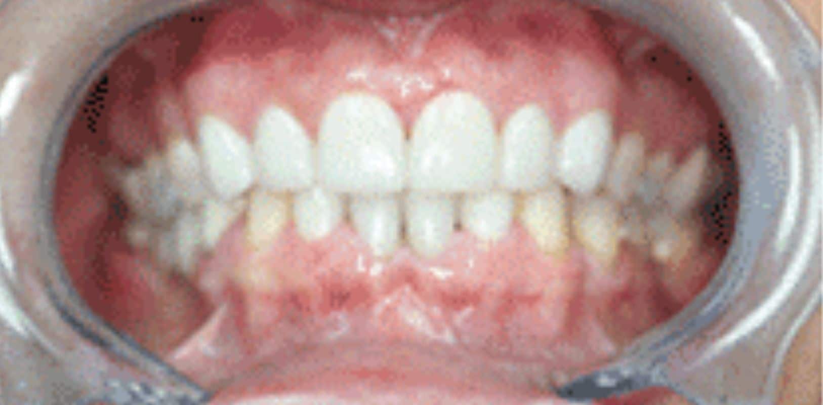 Before & after 23 Smile transformation by doctor anthony martin after treatment 5