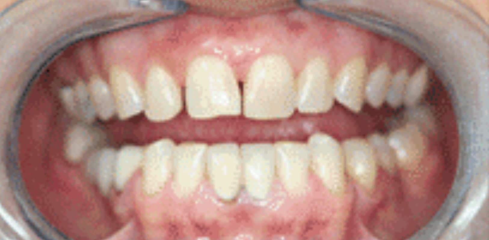 Before & after 22 Smile transformation by doctor anthony martin before treatment 5