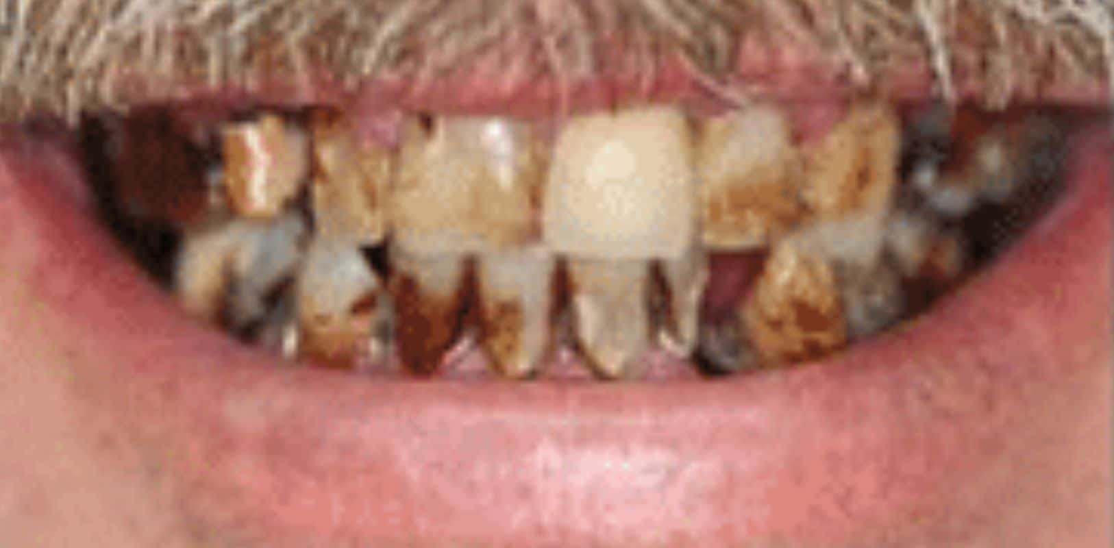 Before & after 26 Smile transformation by doctor anthony martin before treatment 6