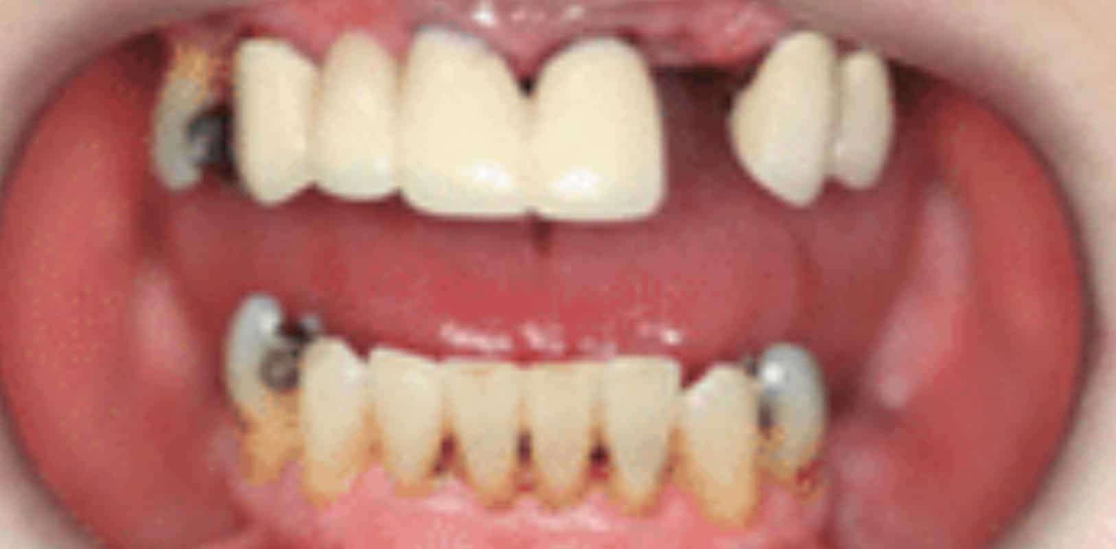 Before & after 16 Smile transformation by doctor anthony martin before treatment 7