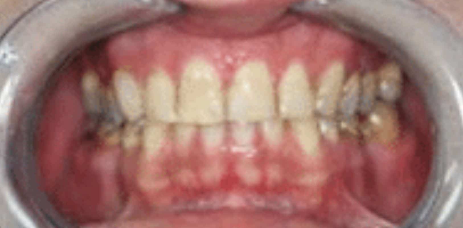 Before & after 14 Smile transformation by doctor anthony martin before treatment 8