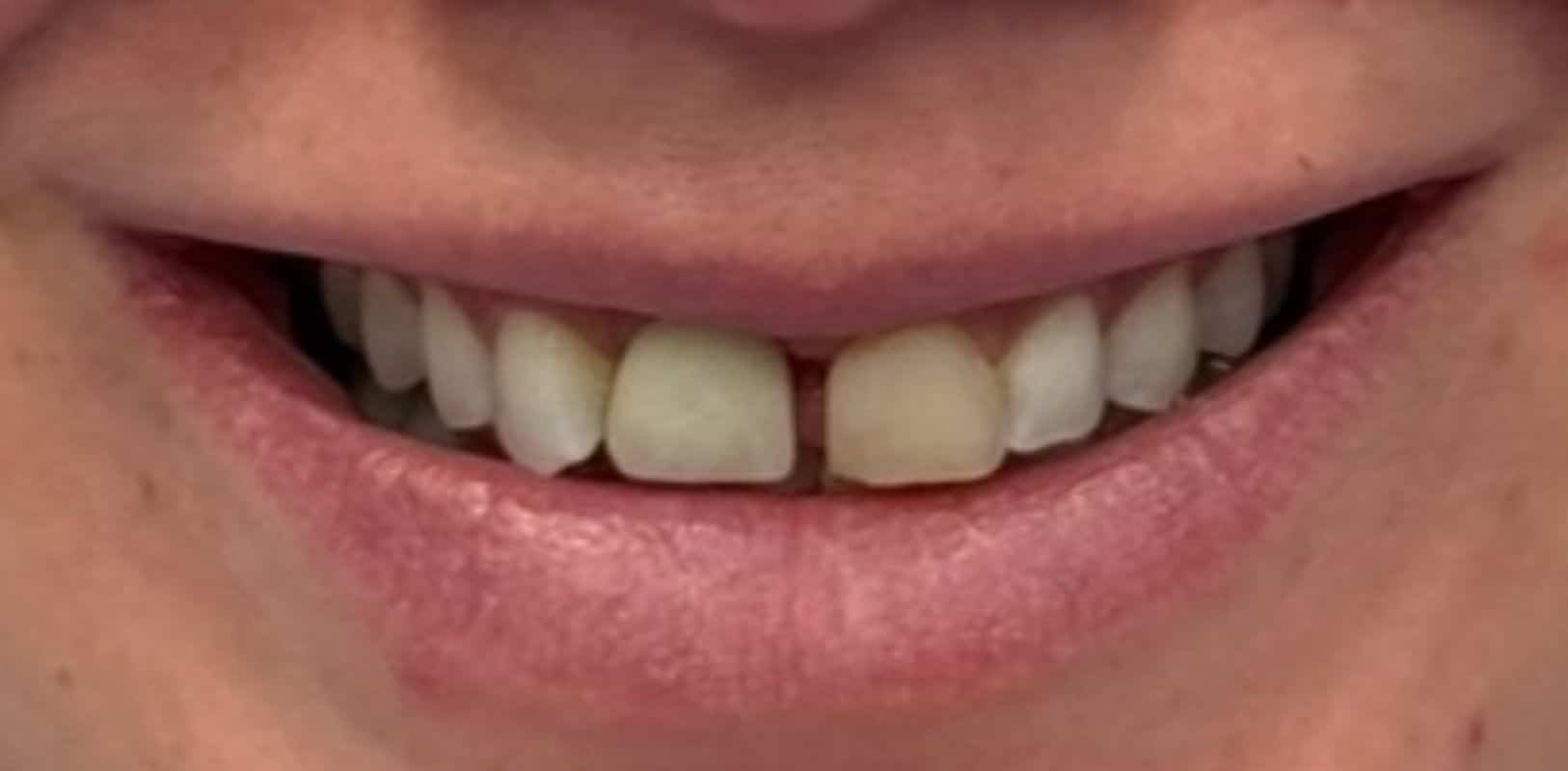 Before & after 8 Smile transformation by doctor anthony martin before treatment 9
