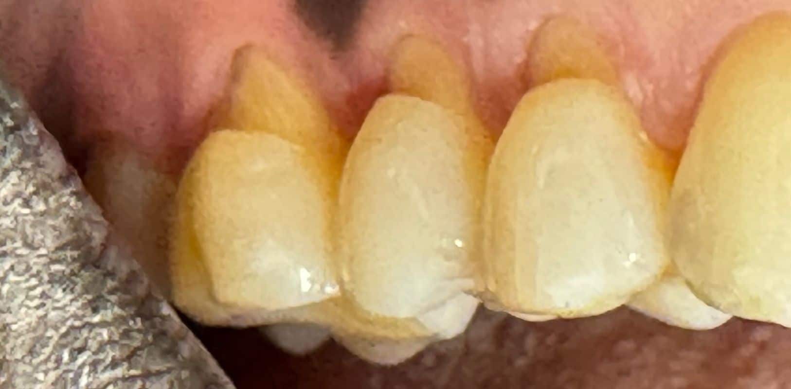 Before & after 10 Martin smile transformatino before treatment