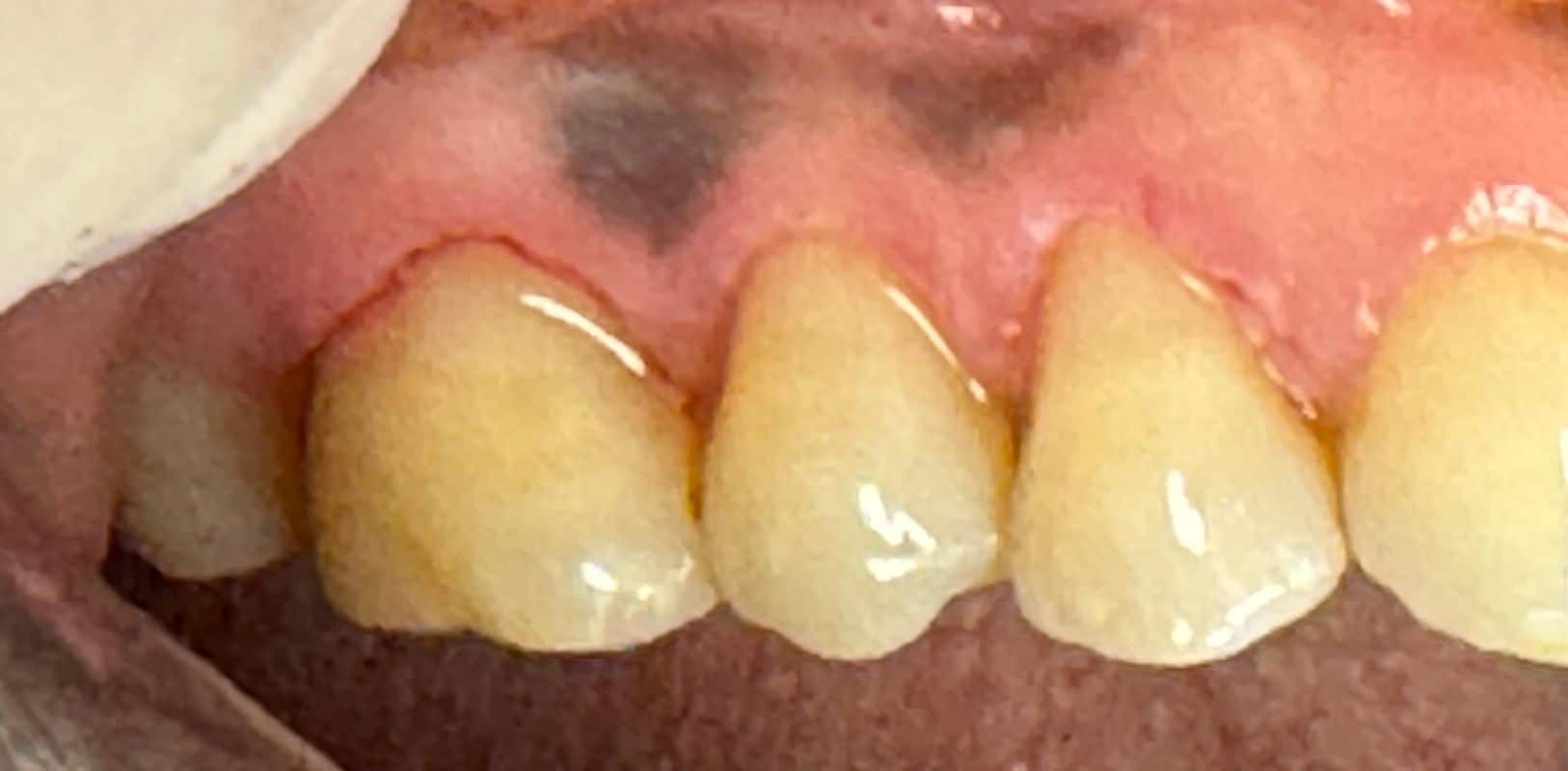 Before & after 11 Martin smile transformatino after treatment