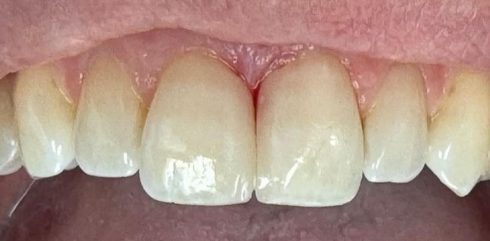 Before & after 7 After martin transformation