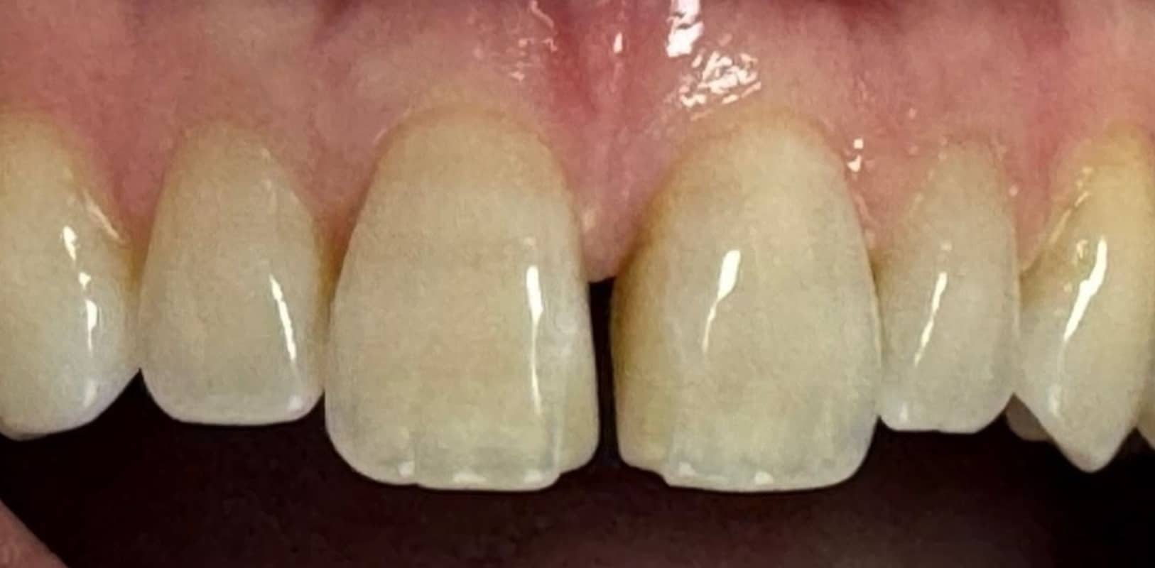 Before & after 6 Gap tooth before martin transformation