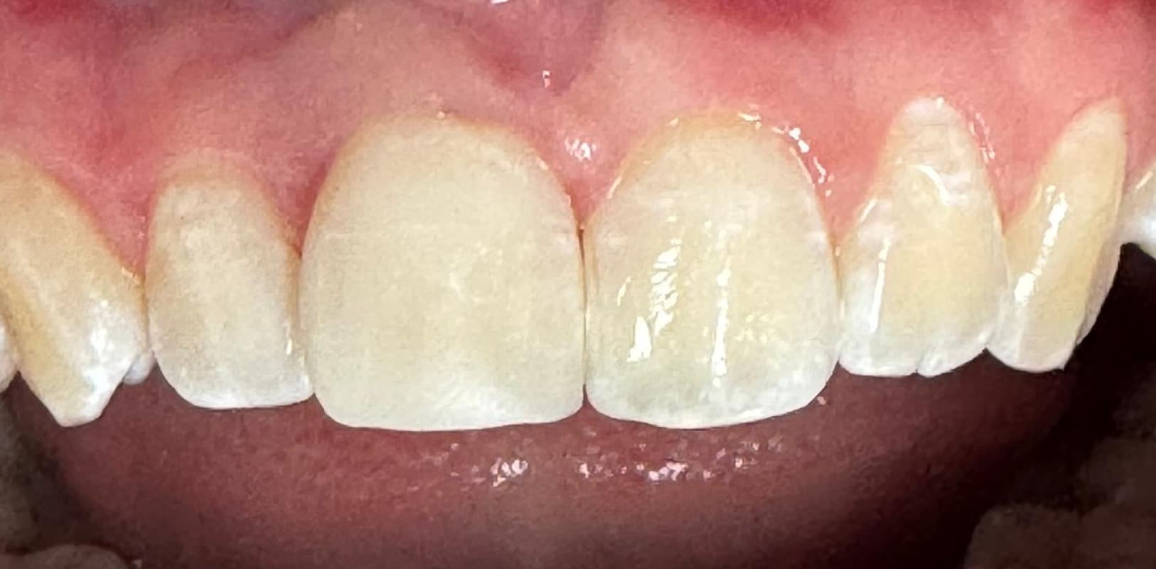 Before & after 5 Fractured tooth after image