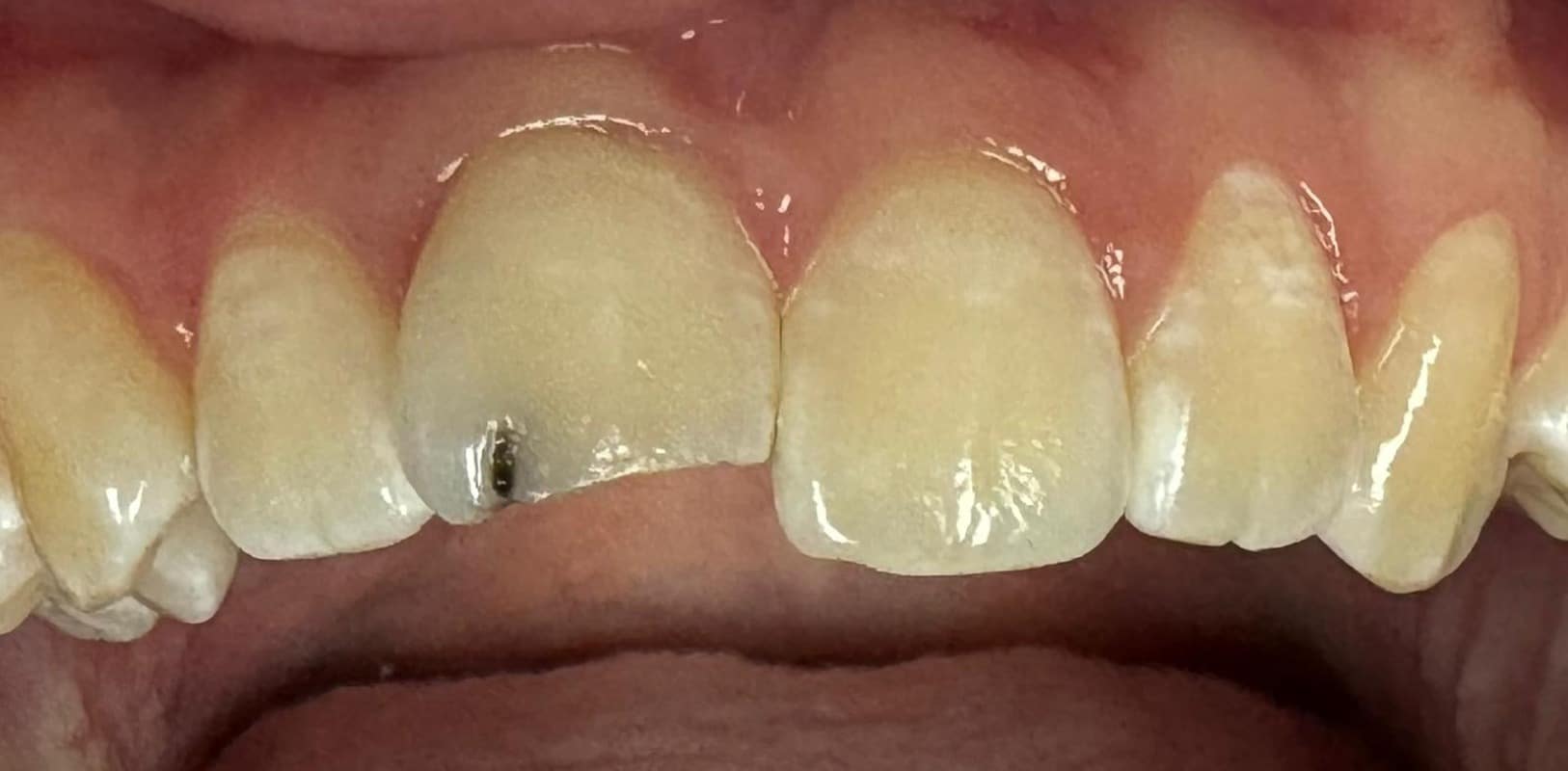 Before & after 4 Fractured tooth before photo