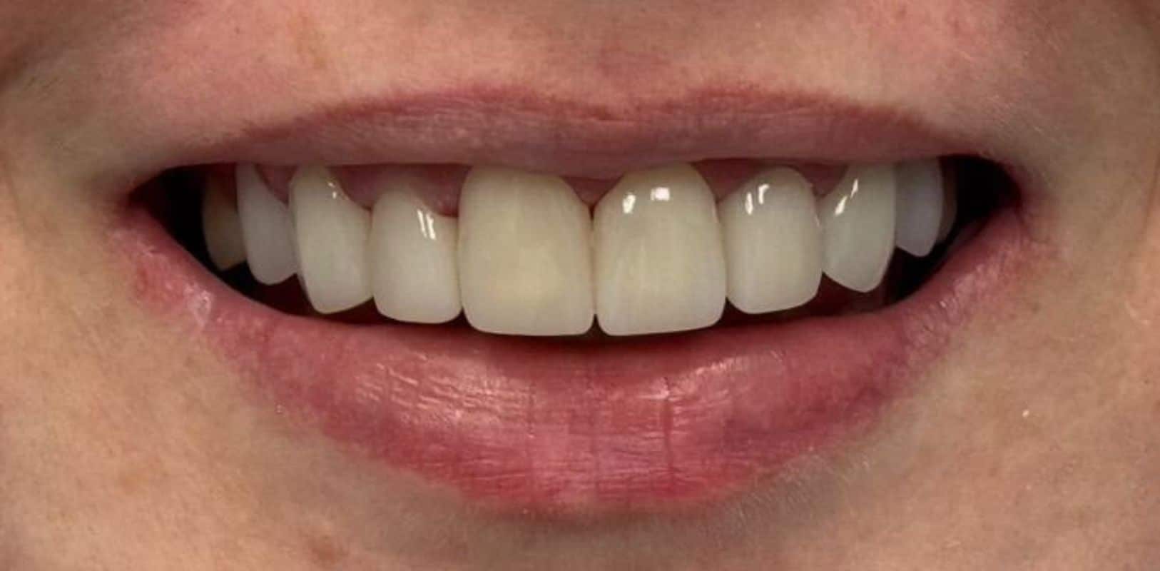 Before & after 3 Patient’s teeth after cosmetic dental treatment at anthony martin dentistry