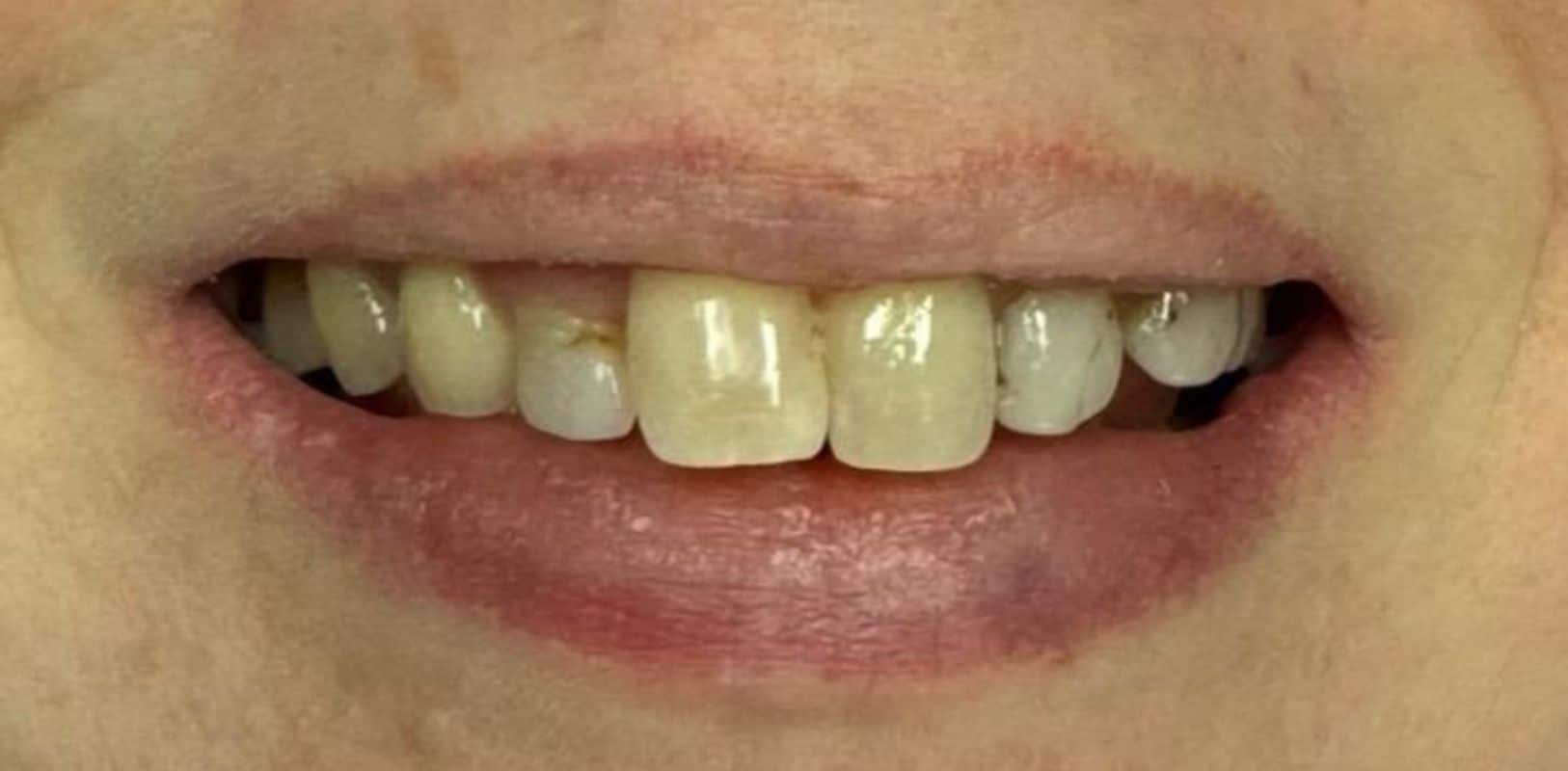Before & after 2 Patient’s teeth before cosmetic dental treatment at anthony martin dentistry